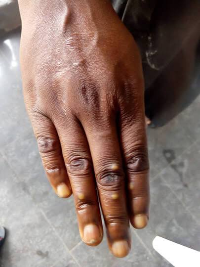 A New Phase of Monkeypox Emerges in Central Africa - Africa.com